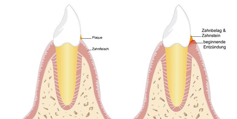 parodontitisbehandlung