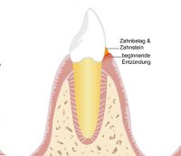 parodontitisbehandlung