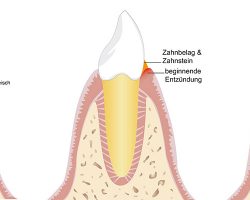 parodontitisbehandlung